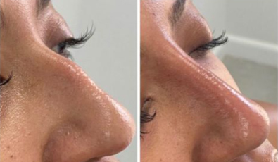 Treatment: Non-Surgical Rhinoplasty Product: Amalian LT Intense Longevity: Lasts up to 18 months Benefits: Immediate Volume Technique: Combination of Cannula and Needles