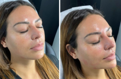 Treatment: Jawline Contouring Product: Amalian Volume Longevity: 18 months plus Benefits: Biphasic, High G Prime Technique: Using a combination of needles and a cannula.Two syringes were used for this correction.